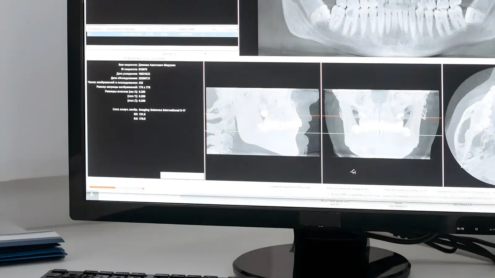 Dental scans on a clinic monitor, including a panoramic view of the full upper and lower arch
