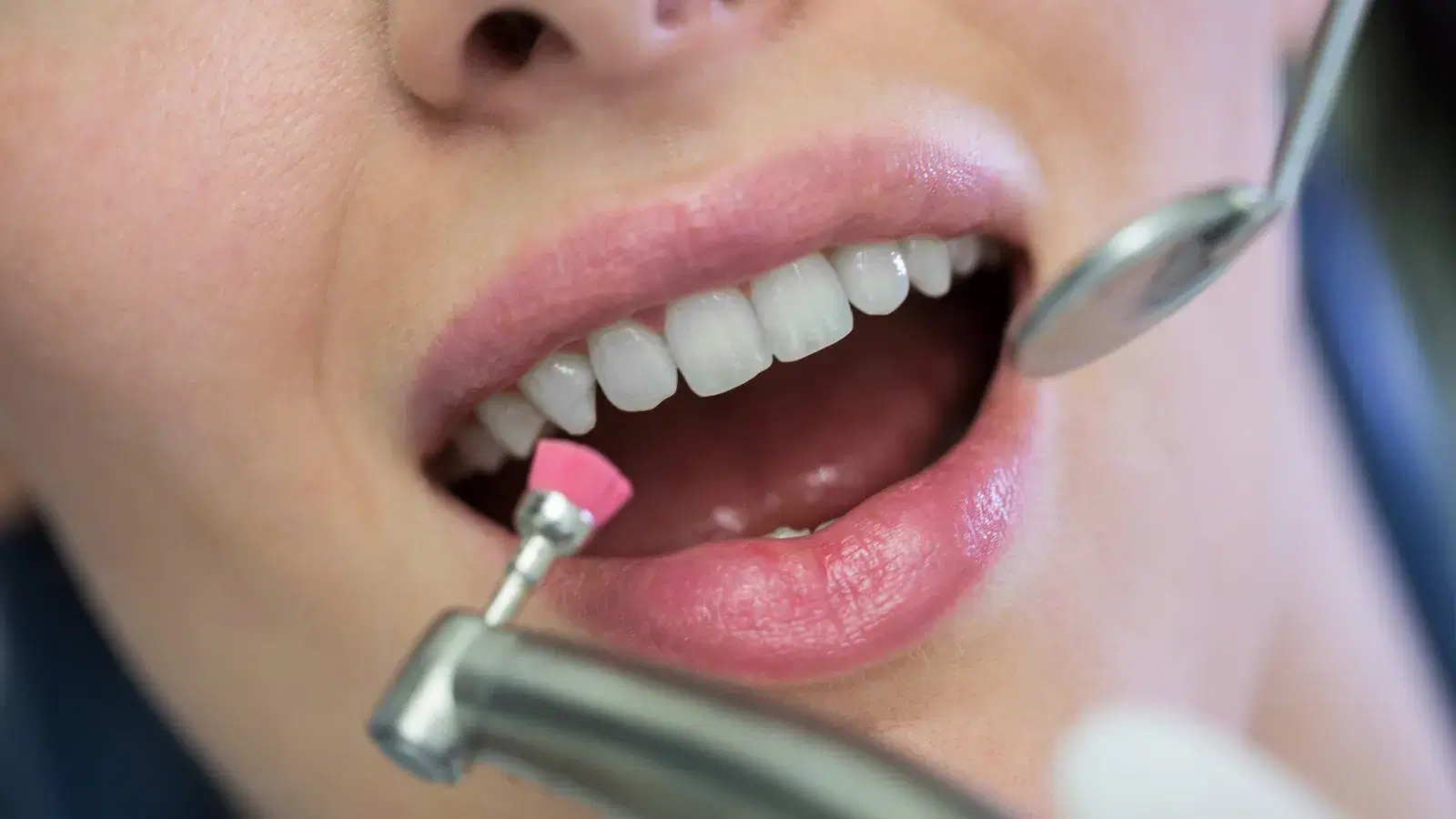 Close-up of a polishing cup and dental mirror against bright front teeth during an in-chair clean