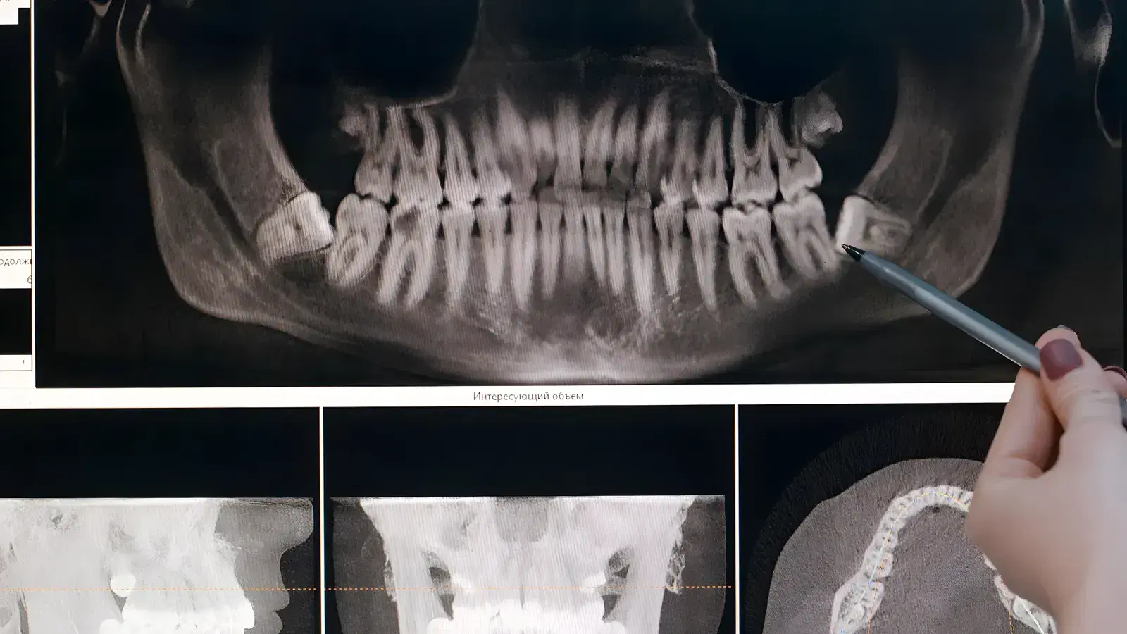 A pen pointing to a lower wisdom tooth on a panoramic dental X-ray shown on a clinic monitor